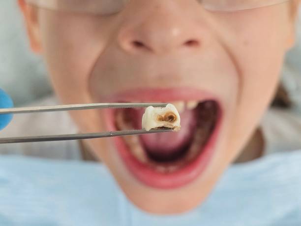 Best Emergency Treatment for Dental Infections or Abscesses in Los Alamitos, CA