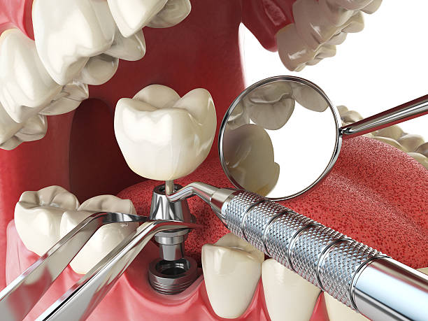 Best Emergency Treatment for Dental Infections or Abscesses in Los Alamitos, CA